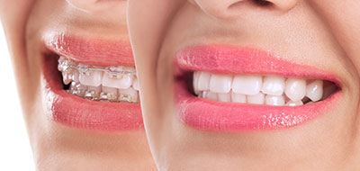 This image features a close-up of a woman s face with a focus on her mouth, showcasing a bright smile and pink lipstick.