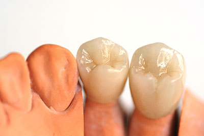 An image of a set of artificial teeth with visible roots, showcasing the dental implant process.