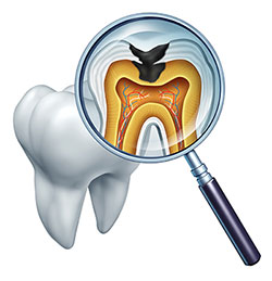 An illustration of a magnifying glass with an internal view of a tooth, showing the root canal and surrounding tissue, overlaid on a dental model.