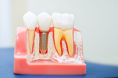 The image shows a model of human teeth with visible dental implants, set against a pink background that resembles a mouth, with a focus on the implant process.