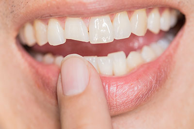 An image of a person holding their finger up to their mouth, with a close-up view of a smile showing teeth and lips.