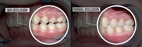 The image displays a side-by-side comparison of two dental implants, with one showing a normal appearance and the other showcasing an area of malocclusion.