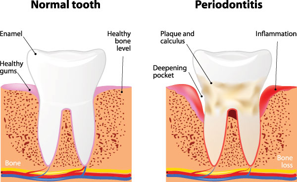 The image is a medical illustration showing three stages of tooth decay, from normal to severe, with annotations indicating the progression of the condition and the effects on the teeth and surrounding tissues.