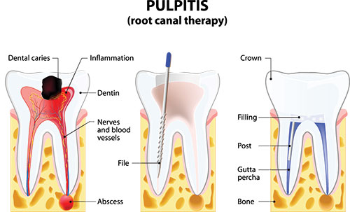 The image is a medical illustration showing the process of pulpitis, with labels indicating different parts of the tooth and surrounding tissue.