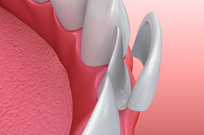 The image shows a close-up of a dental implant with an abutment, which is the connecting piece between the implant and the crown or bridge.