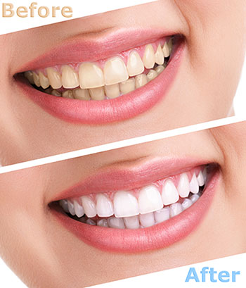 Before and after teeth whitening display showing a person s smile with noticeable teeth brightening effect, emphasizing the transformation.