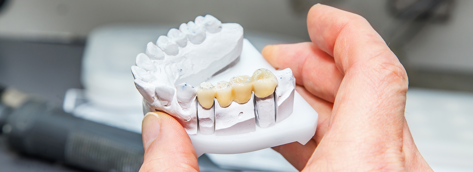 The image shows a person s hand holding a set of artificial teeth, with the teeth having visible dental implants.