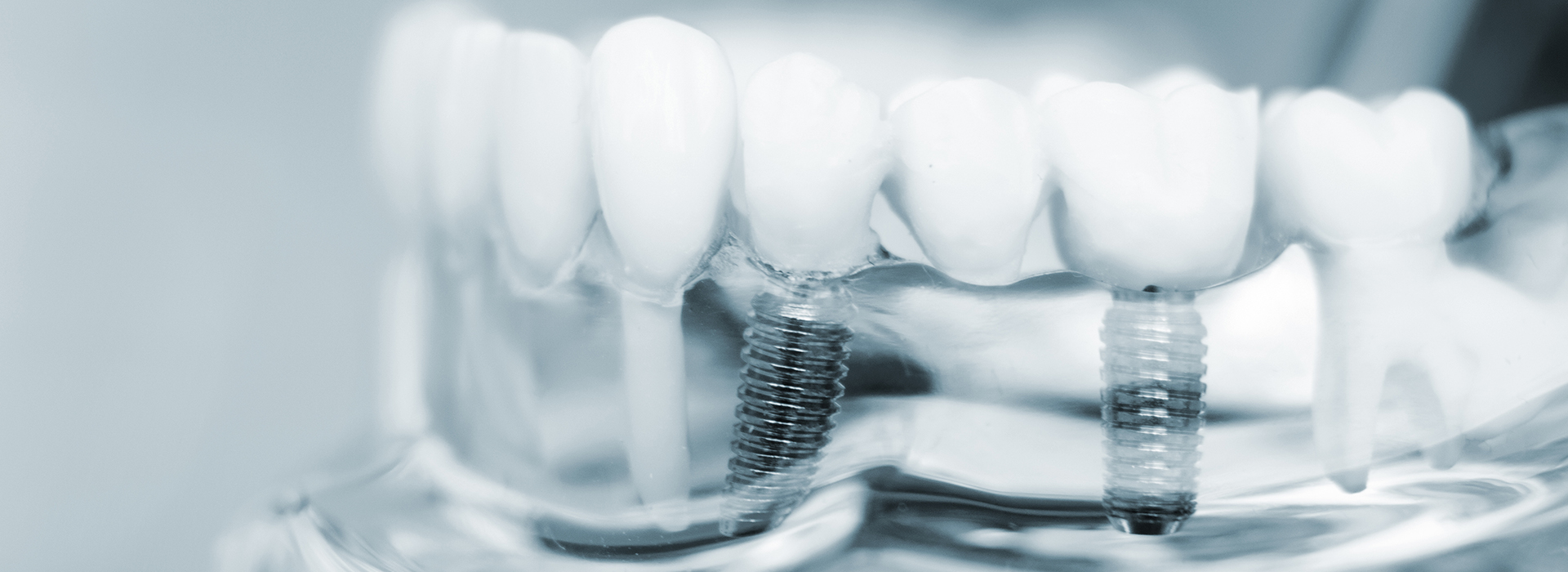 An image of a close-up view of several teeth with visible orthodontic braces and wires, set against a blurred background.